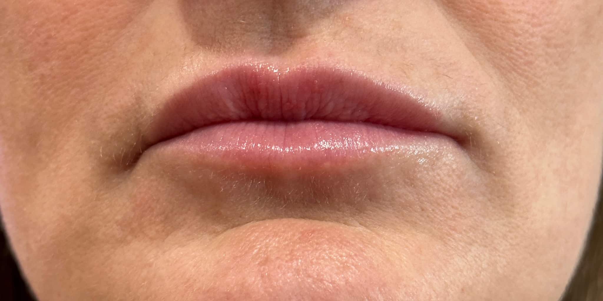 After Image: 1 syringe of filler - front