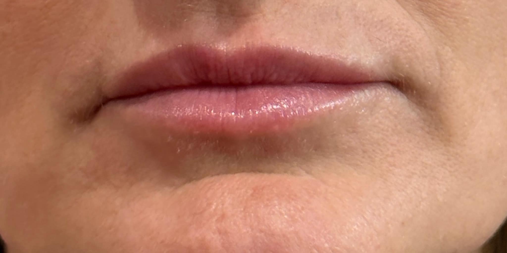 Before Image: 1 syringe of filler - front