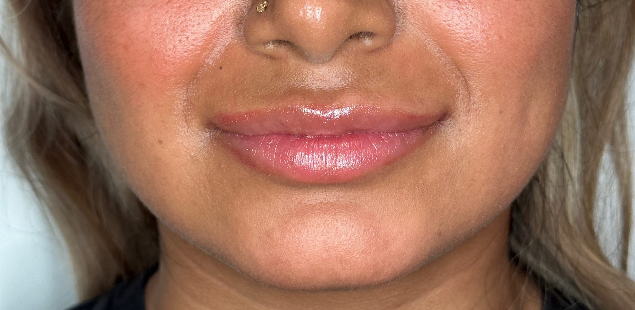 After Image: 1 syringe of filler