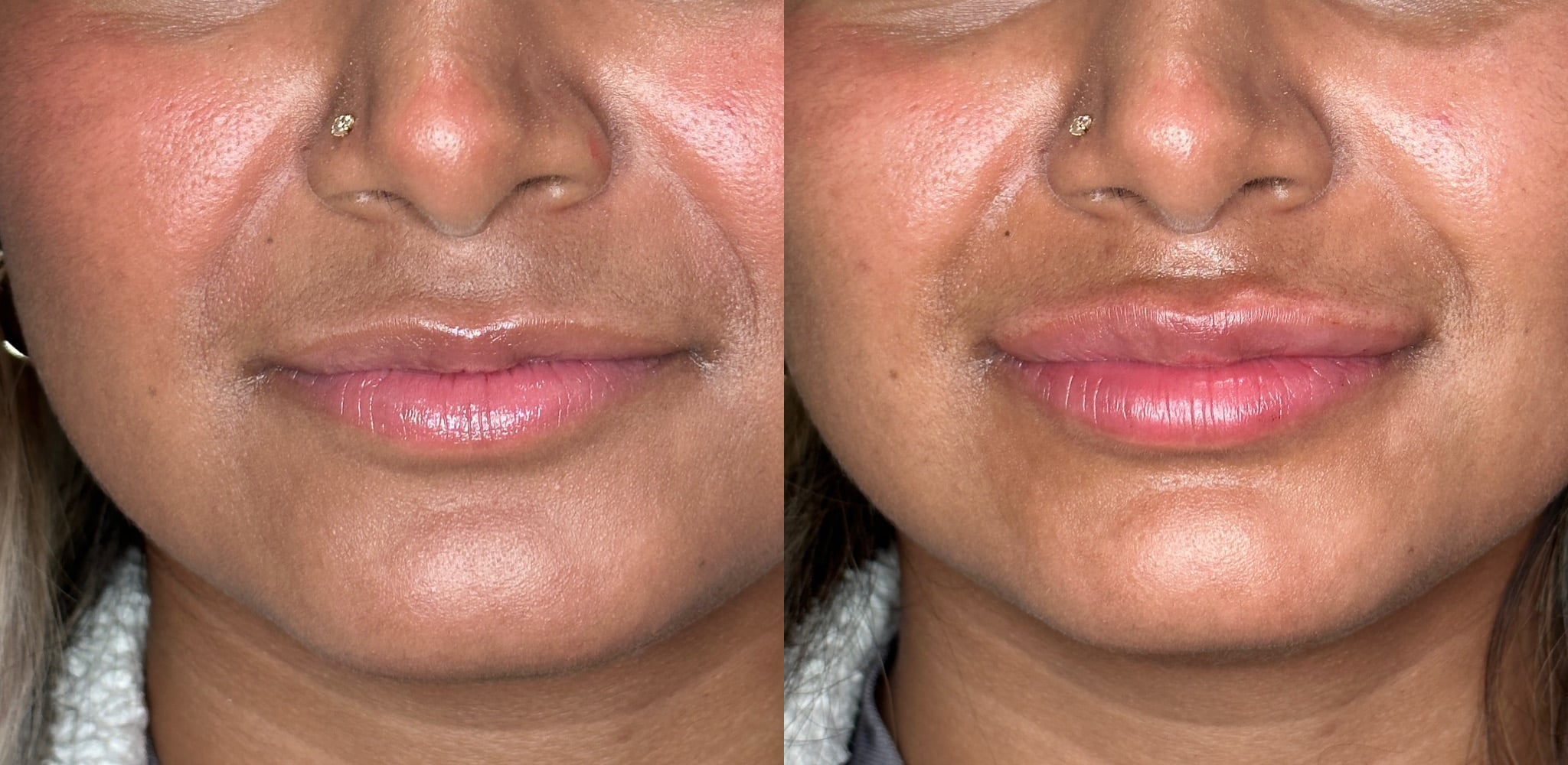 Before Image: 1 syringe of filler