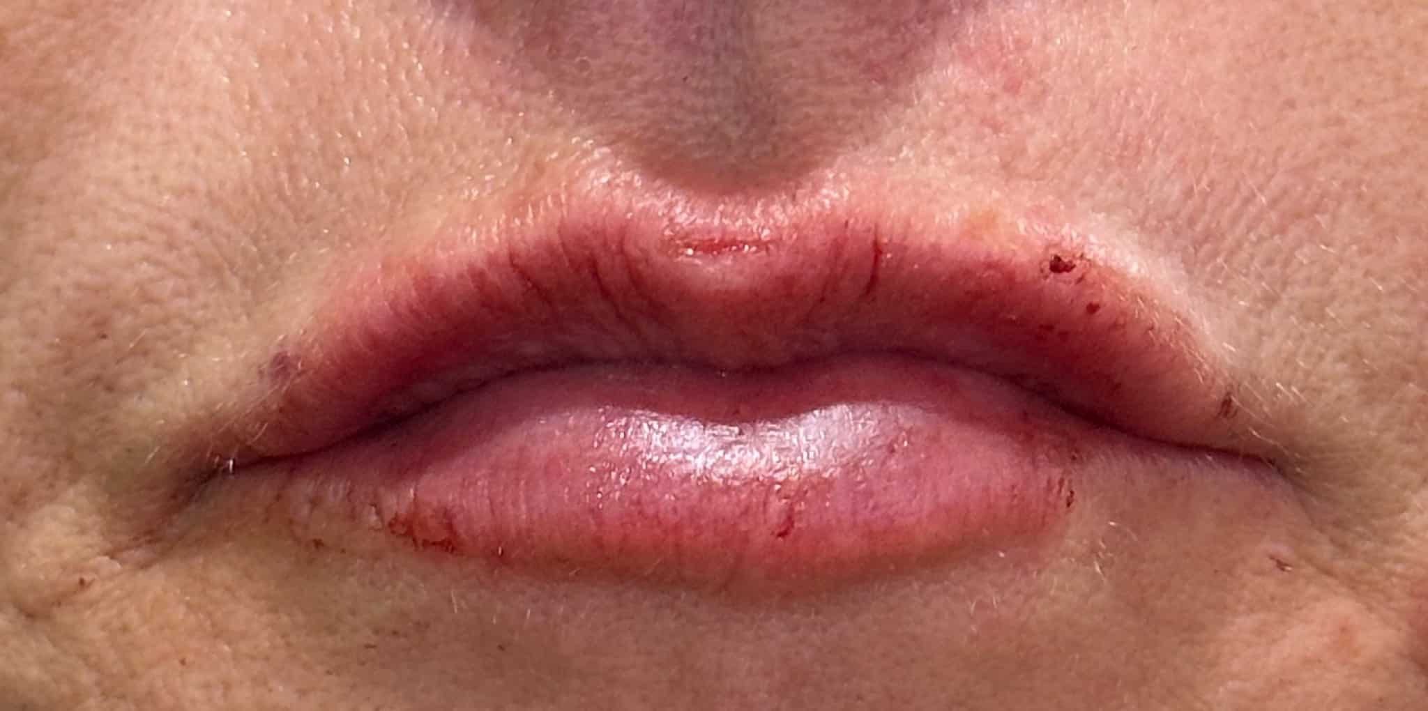 After Image: 1 syringe of filler