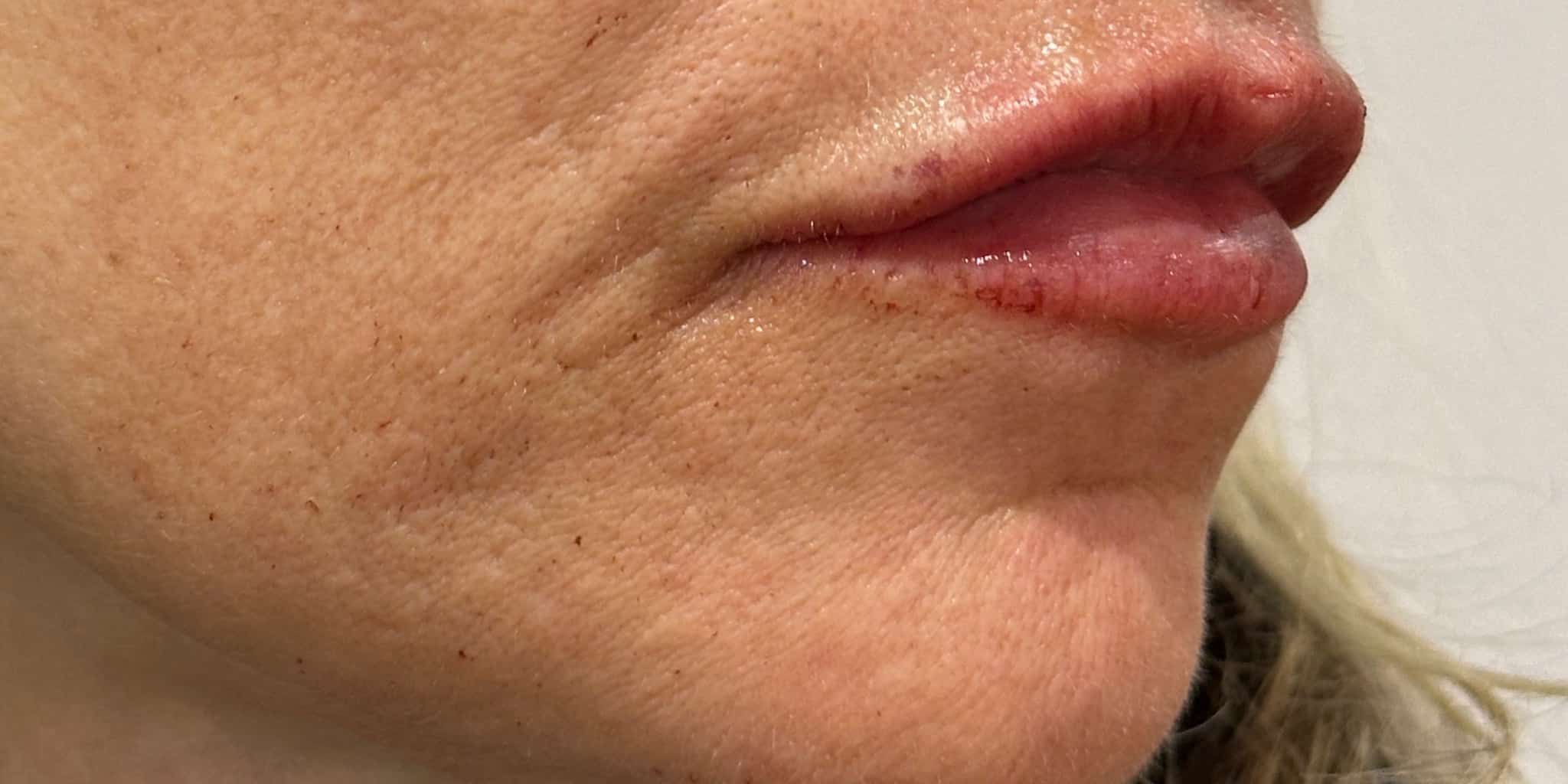 After Image: 1 syringe of filler - right-side