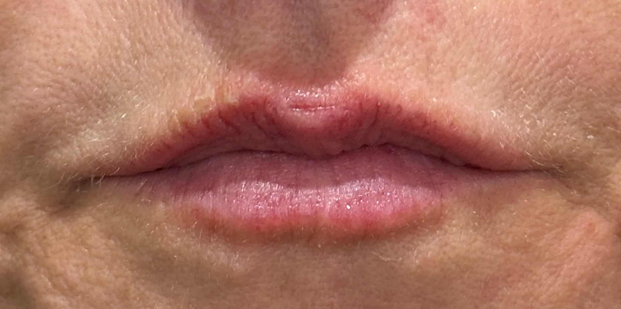 Before Image: 1 syringe of filler
