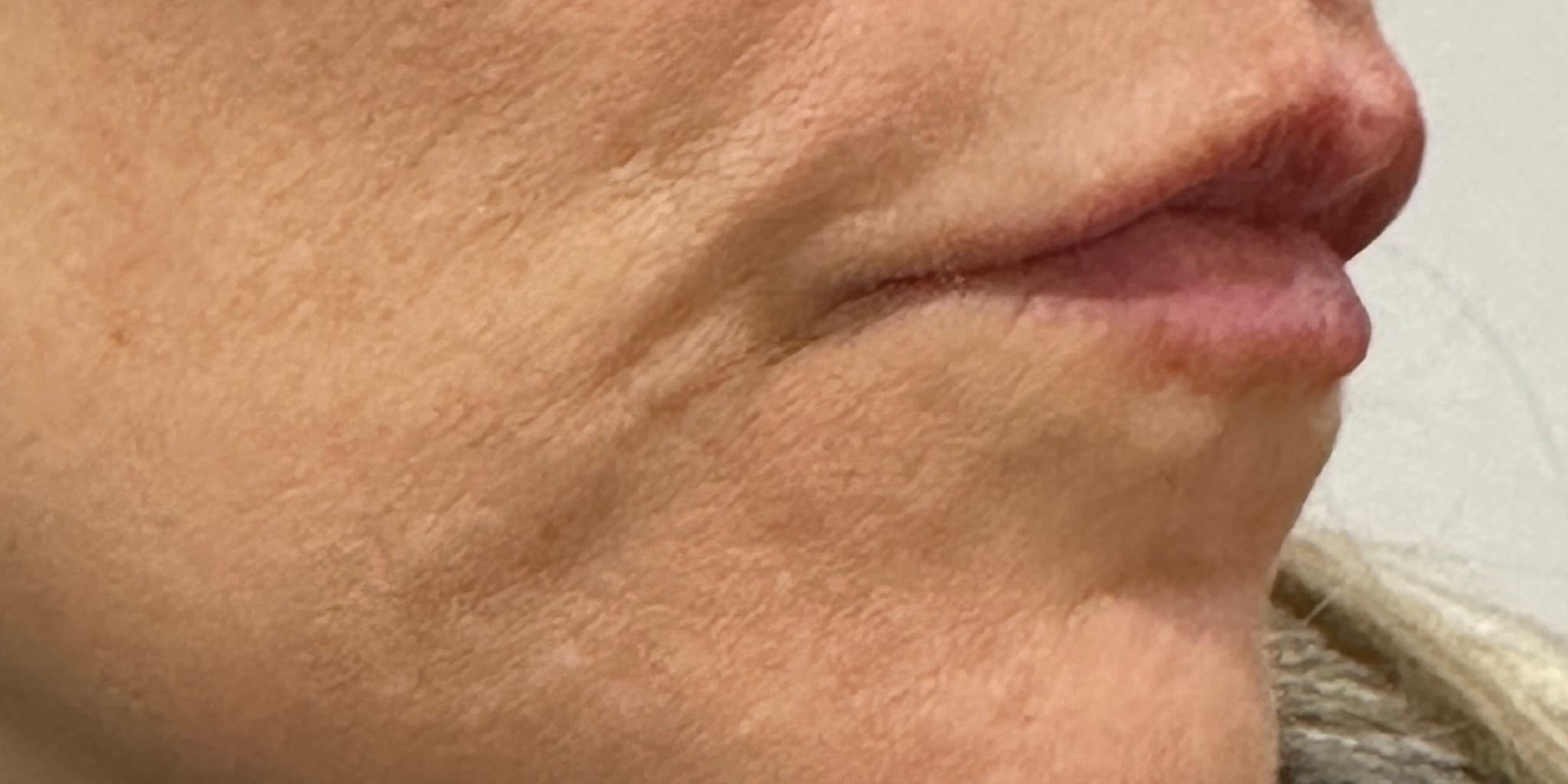 Before Image: 1 syringe of filler - right-side