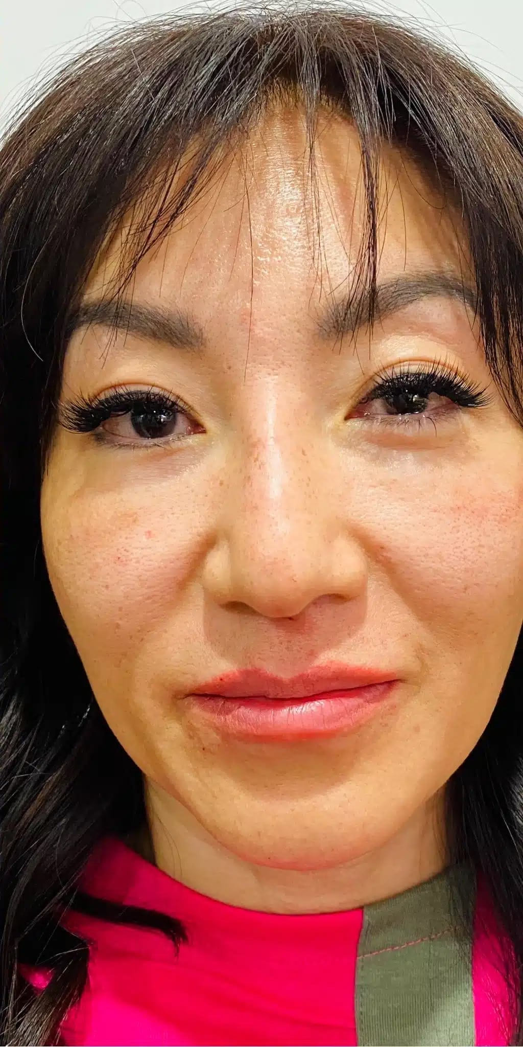 After Image: 1 syringe of filler - front
