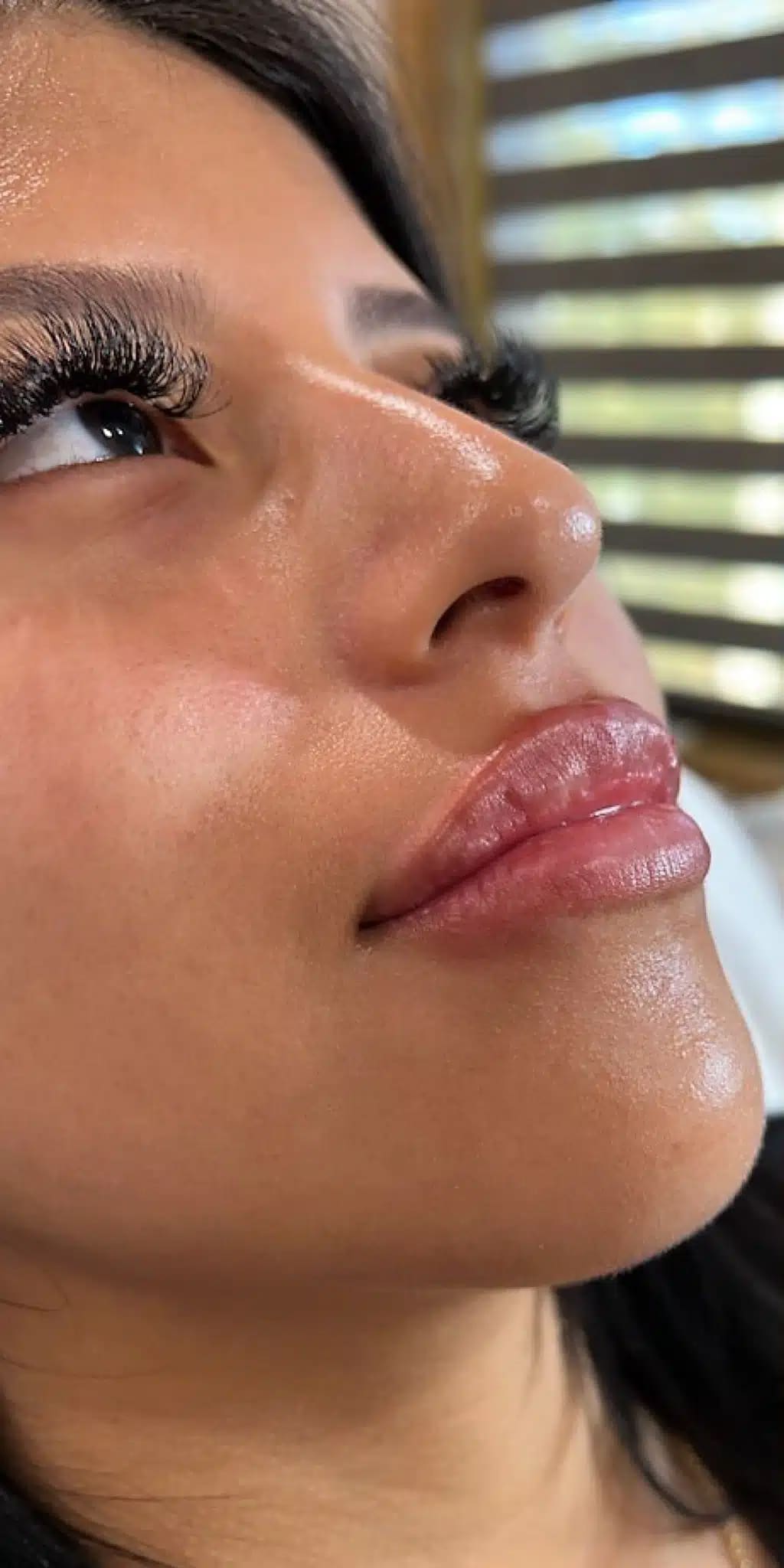 Before Image: 1 syringe of filler - right-front-oblique