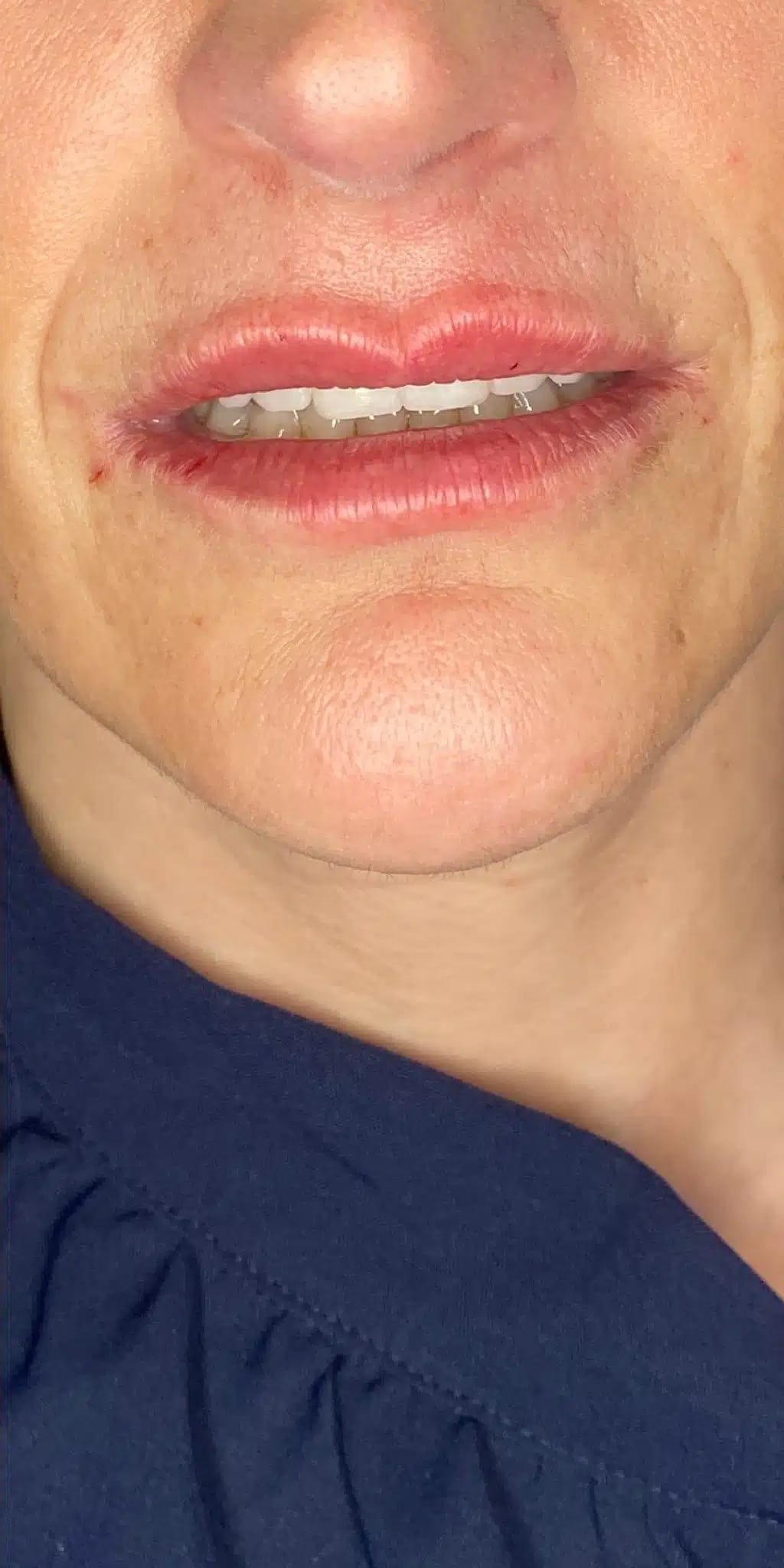 After Image: 1 syringe of filler