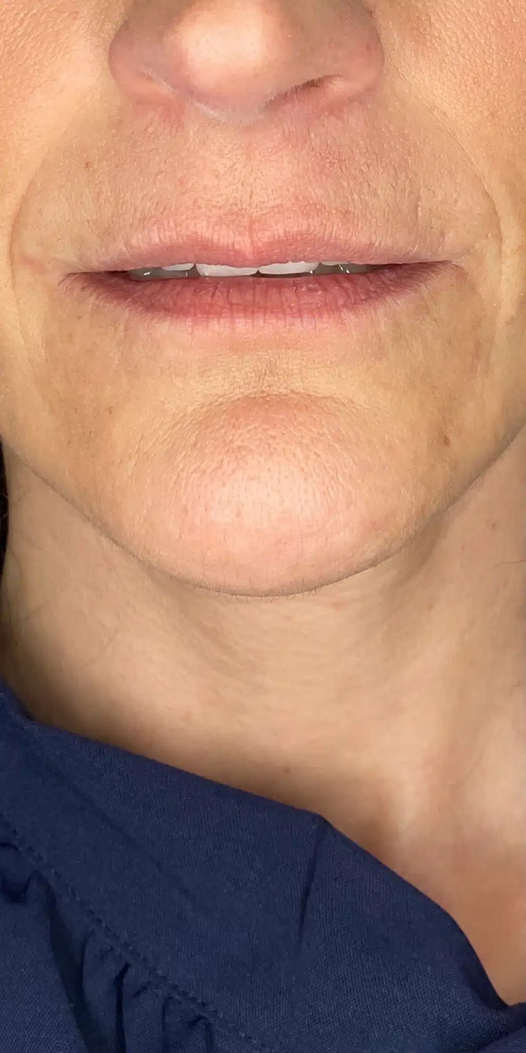 Before Image: 1 syringe of filler